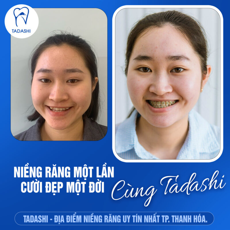 Review nha khoa niềng răng uy tín chất lượng tại Thanh Hóa