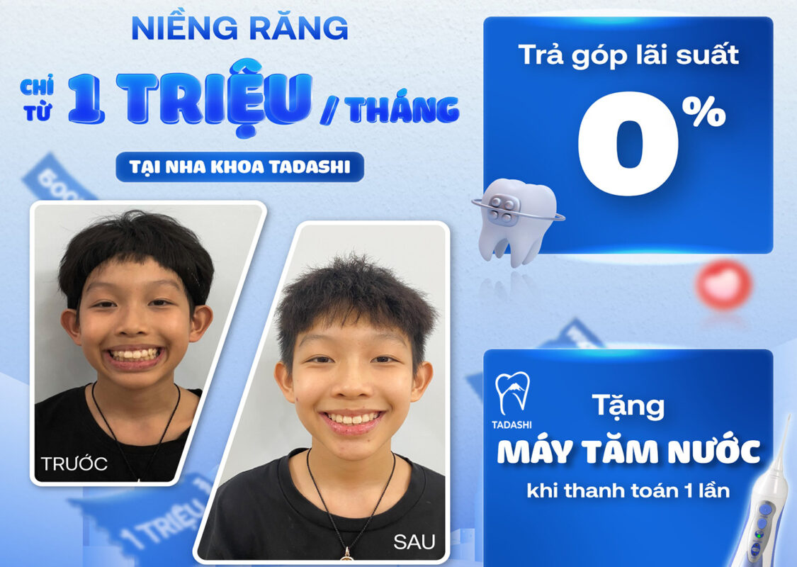 Thời Điểm Vàng Để Chỉnh Nha Cho Bé - Thời Điểm Chỉnh Nha Tốt Nhất Ở Trẻ Em
