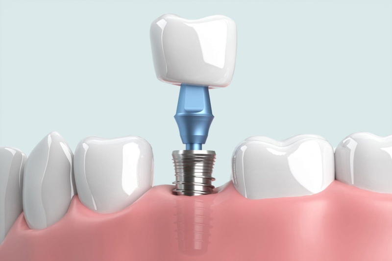 Quy-Trình-Cấy-Implant-tại-Nha-Khoa-Tadashi-Thanh-Hóa