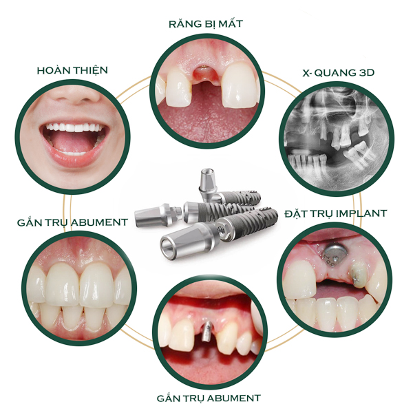 quy-trinh-cay-implant