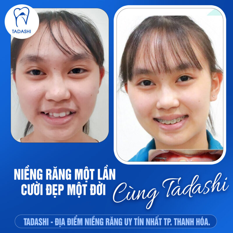 niềng răng ở đâu tốt tại thanh hóa