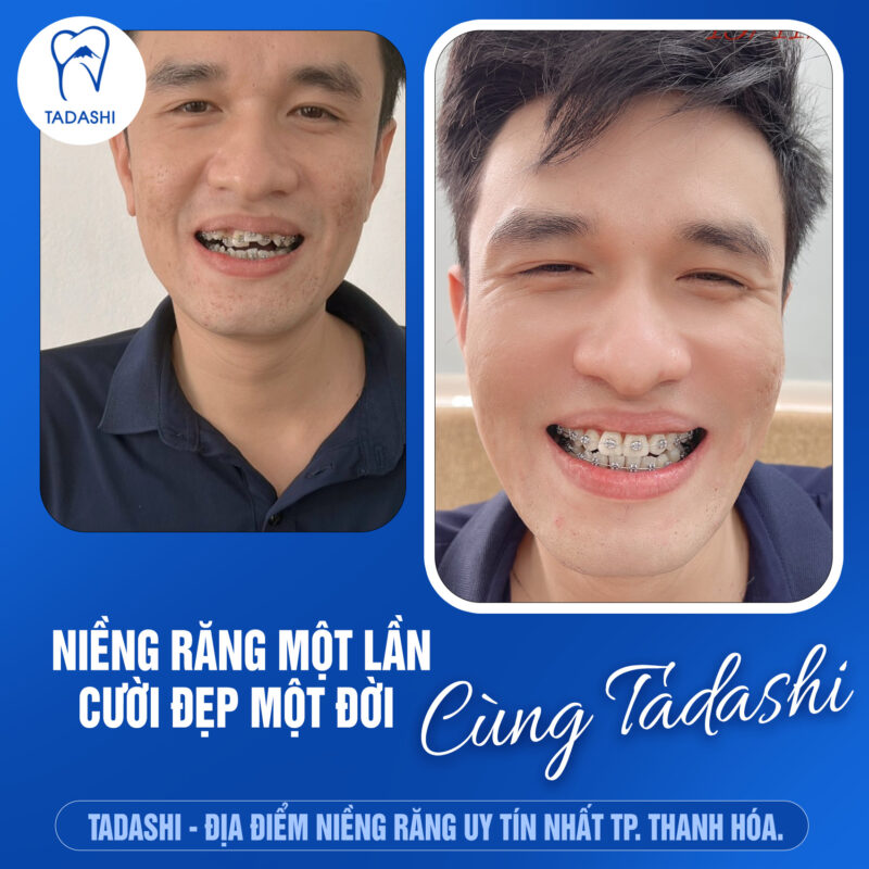 dịch vụ niềng răng uy tín tại thanh hóa